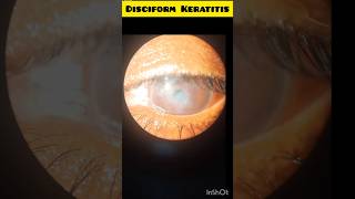 Disciform Keratitis  DisciformKeratitis educational [upl. by Ihpen429]