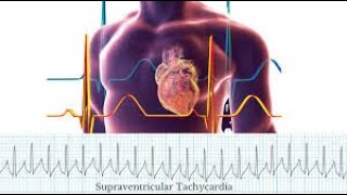 Supraventricular Tachycardia  SVT  types  symptoms management  Supraventricular tachycardia ECG [upl. by Aldos604]