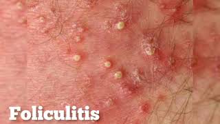 FOLICULITIS FOLÍCULO INFLAMADO CAUSAS SÍNTOMAS Y TRATAMIENTO [upl. by Tisbe]