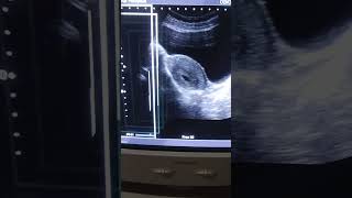 Gestational sac of 4 weeks with transabdominal ultrasound by medical radiology [upl. by Anesusa312]