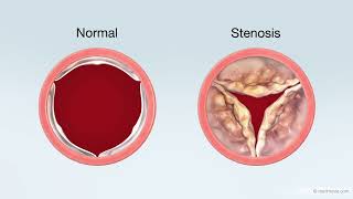 Transcatheter Aortic Valve Replacement TAVR Treatment for Aortic Stenosis [upl. by Ynohtnaleahcim]