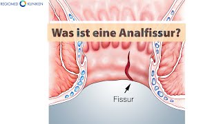 REGIOMED Kliniken Was ist eine Analfissur Analfissur Symptome  was tun [upl. by Stephens821]