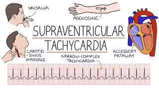 Understanding Supraventricular Tachycardia SVT [upl. by Upton]