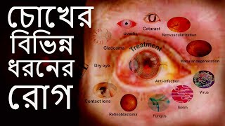 চোখের বিভিন্ন ধরনের রোগ এবং তাদের লক্ষণ16 type of Eye Diseases [upl. by Adnawaj]