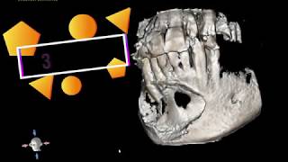 Mandibular Cyst [upl. by Sears]