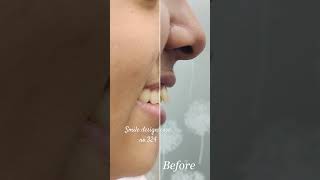 Braces before afterBraces smile Invisalign Invisible braces [upl. by Quick]