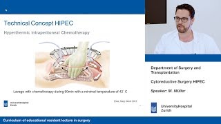 Cytoreductive Surgery HIPEC – Please participate in our 3minute survey below [upl. by Dobbins]