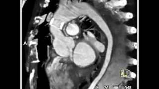 Type B dissection with compression of true lumen [upl. by Harlin]