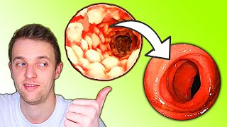 The Quickest Way to Escape a Flare of Ulcerative Colitis [upl. by Whitford]