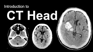 Introduction to CT Head Approach and Principles [upl. by Helbona]