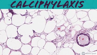 Calciphylaxis A Deadly Complication of End Stage Renal Disease ESRDChronic Kidney Disease [upl. by Llevram]