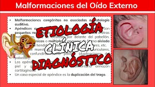 ⚕️🩺 Malformaciones del Oido Externo Atresia Macrotia Microtia Anotia  Otorrinolaringología [upl. by Namlak199]