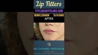 Best Lip Fillers In Lebanon by Doctor Charbel Medawar lipfillers plasticsurgery cosmetics beauty [upl. by Annemarie732]