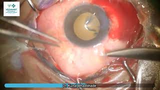 Pterygium excision Conjunctival Autograft Sutureless Glueless [upl. by Callum140]