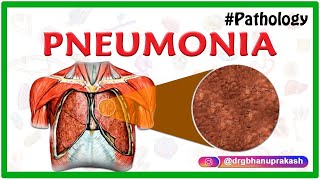 PNEUMONIA  PATHOLOGY ANIMATED VIDEO LECTURE [upl. by Ahsilaf]