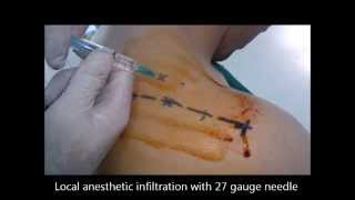 Suprascapular nerve block Meier approach [upl. by Bunting]