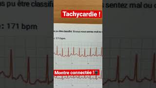 Une tachycardie sur la montre connectée [upl. by Redla]