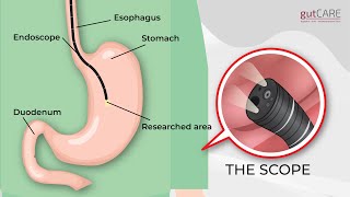 Preparing For Your Gastroscopy OGD  GUTCARE [upl. by Einnus]