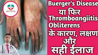 Buergers Disease। Thromboangiitis Obliterens बर्गरस बीमारी के कारण लक्षण ईलाज। पूरी जानकारी। [upl. by Kcire]