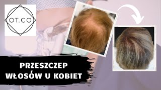 Przeszczep włosów u kobiet  OTCO Clinic [upl. by Atniuq]