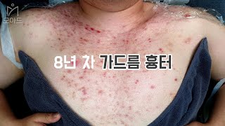 8년 동안 고생했던 가드름 흉터 개선 후기  건대 피부관리 모아드 Chest Acne Scars Skin care reviews [upl. by Irelav]