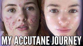 My Accutane Journey with Progress Photos and Relapse Experience [upl. by Grani]