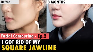 SUB FACIAL CONTOURING 3 MONTHS UPDATE  Square Jawline amp Protruding Cheekbone Reduction in Korea [upl. by Infeld]