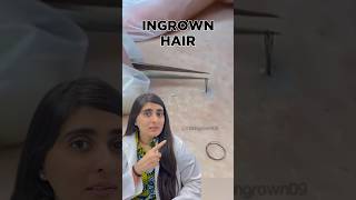 Ingrown Hair Removal  Ingrown Hair Treatment  Ingrown Hair Dermatologist [upl. by Asiek541]