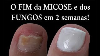 O FIM DAS MICOSES E FUNGOS NAS UNHAS EM 2 SEMANAS Feat Kátia Rosenberg por Joyce Vignochi [upl. by Iraj]