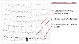 ECG BASICS I PREMATURE VENTRICULAR COMPLEX PVC I BIGEMINY [upl. by Enneiviv]