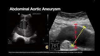 AAA and ABDO Emergencies [upl. by Leorsiy288]