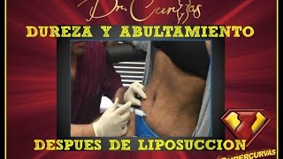 Liposucción y Efectos Secundarios  Dr Cortes [upl. by Esidnac]