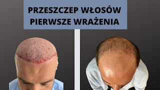 Przeszczep włosów w Turcji  pierwsze wrażenia [upl. by Winchell]