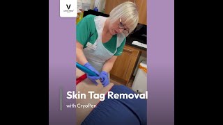 Skin Tag Removal with CryoPen at DRVICTORIA™ Clinic in Edinburgh [upl. by Singer]