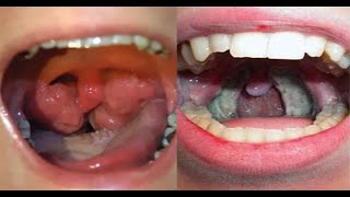 Tonsillectomy [upl. by Vinson]