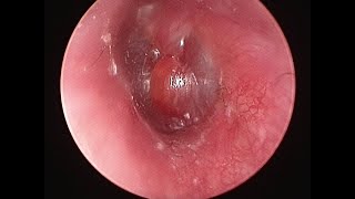 Bullous Myringitis  Otoendoscopy [upl. by Papageno913]