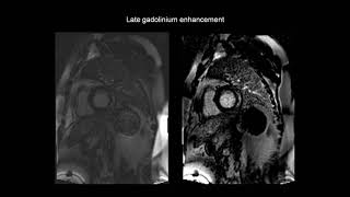 How to assess myocarditis with the help of cardiac MRI CMR [upl. by Anhpad]