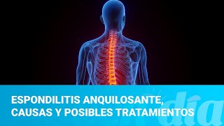 Espondilitis anquilosante causas y posibles tratamientos [upl. by Takeo]