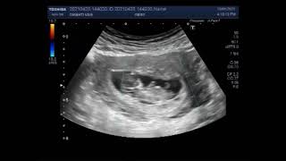 Ultrasound Video showing Single fetal death in twin pregnancies called Vanishing Twin Syndrome [upl. by Wenda]