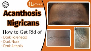 Acanthosis Nigricans How to Get Rid of Dark Neck amp Armpits  Dr Nivedita Dadu [upl. by Ovida56]