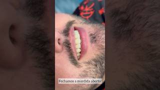 Fechando mordida aberta anterior com facetas em resina composta Resultado natural sorrisolindo [upl. by Brawley]