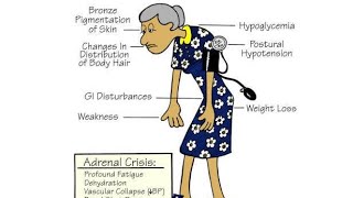 Addisons syndrome and Addisons crisis  medicine 40 [upl. by Elttil]