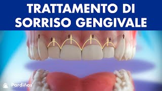 Gengivectomia  Trattamento di sorriso gengivale © [upl. by Morly]