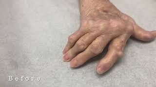 Rheumatoid Hand Deformity Update 3 Months after Surgery [upl. by Auka]