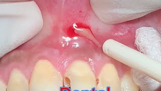 Dental Abscess Drainage [upl. by Dorej371]