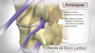 Hernia discal [upl. by Fauver516]