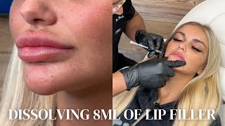 Dissolving 8ml of Lip Filler Insane Results [upl. by O'Meara]