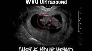 Check the Head Fetal Anencephaly [upl. by Vern573]