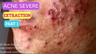 Mụn trứng cá mạch lươn cực nặngDermatologist pimples blackhead acne conglobata extraction part 1 [upl. by Fennell]