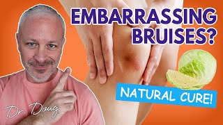 BRUISES How to get rid of them Fast  Dr Doug Willen [upl. by Andromada]